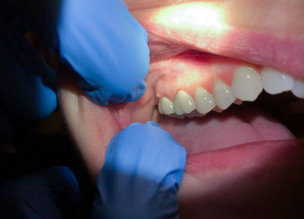 Best Urgent Dental Care in Saunders Lake, OR