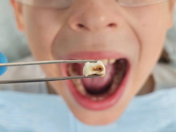 Best Emergency Broken Tooth Repair in Saunders Lake, OR
